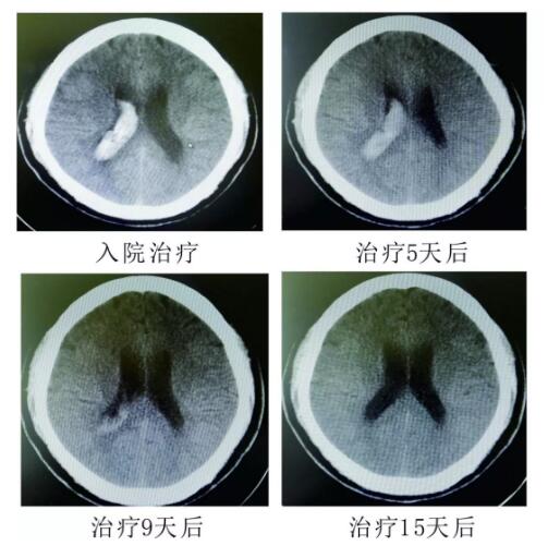 腦出血你不得不引起重視的疾病?。?！