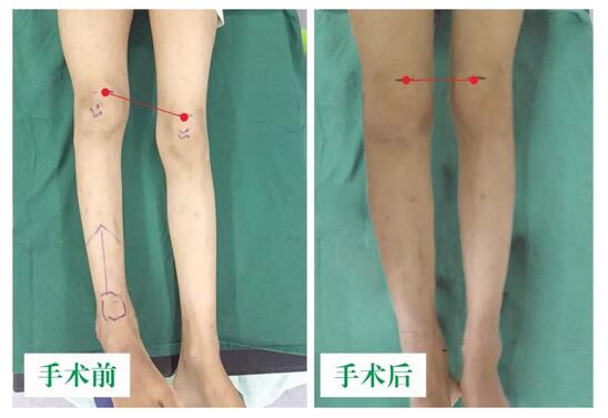 女孩墜梯右腿縮短5cm，幸得醫(yī)生及時(shí)診治恢復(fù)正常腿型