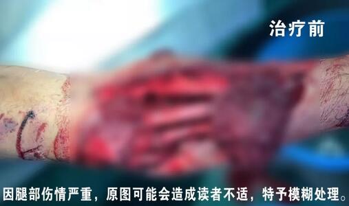 感謝安利醫(yī)院挽救了我的腿，沒(méi)有讓我落下殘疾……”