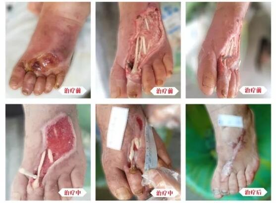 糖尿病并發(fā)癥有多可怕，及時(shí)治療糖尿病足避免截肢！