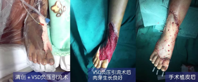 車禍猛如虎，救治如“華佗” ，手術(shù)＋康復(fù)，8歲小女孩車禍后日漸康復(fù)行走