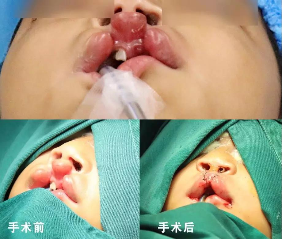 唇腭裂盡早治療消除孩子自卑心理，快樂成長！