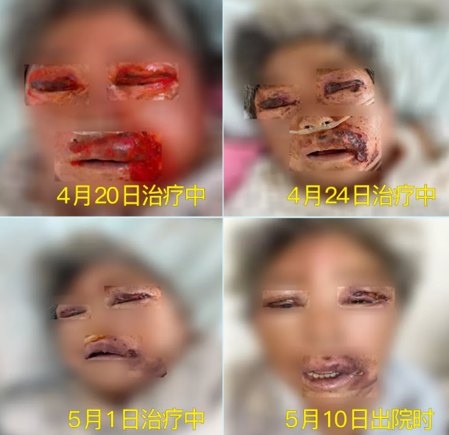 膿毒血癥（急性頜面部蜂窩組織炎）多學(xué)科聯(lián)合會(huì)診，幫助患者成功治愈！