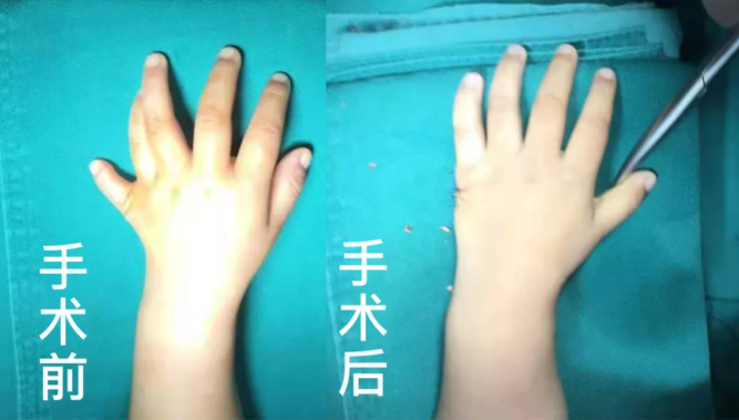 【保山安利醫(yī)院】2歲小兒手、足多指（趾）成功修復(fù)(矯正）！