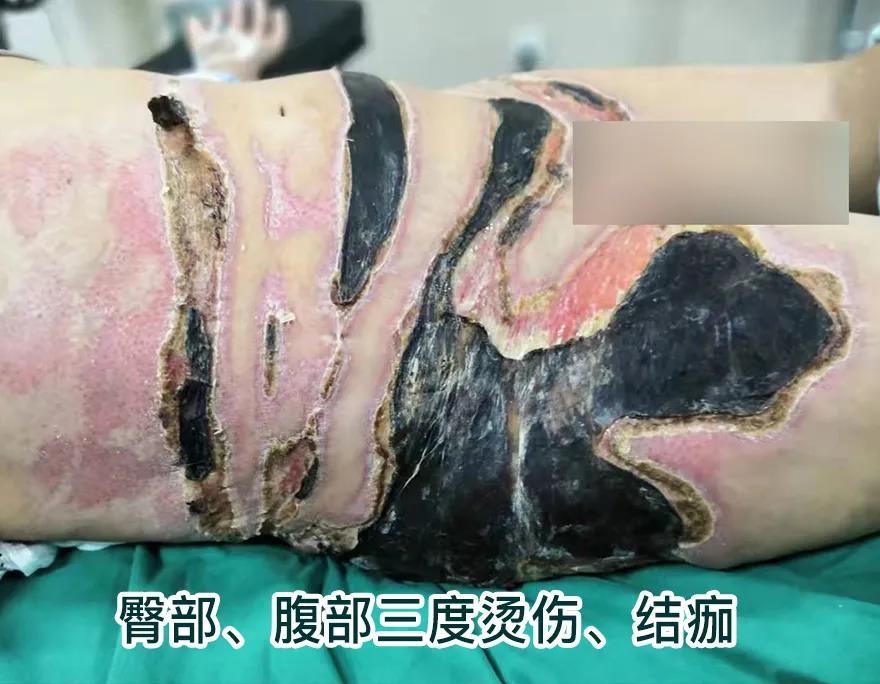 【保山安利醫(yī)院】80歲老人不慎燒傷，導(dǎo)致腹部、右側(cè)臀部大面積創(chuàng)傷，經(jīng)植皮治療創(chuàng)面逐漸愈合