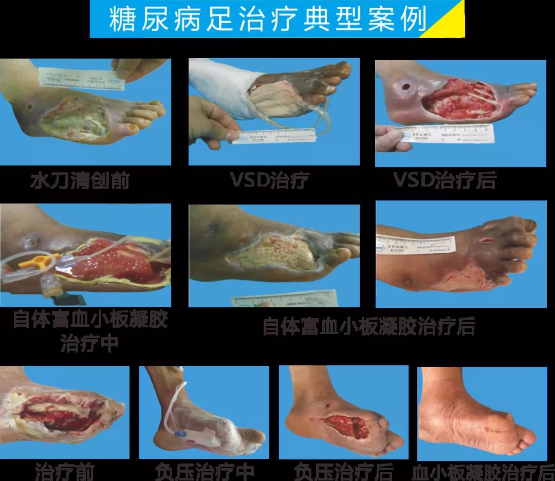 截肢、失明，甚至……，我們要做的是將糖尿病并發(fā)癥遏制在搖籃里！