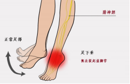 【保山安利醫(yī)院—健康科普】什么是足下垂！你了解嗎？