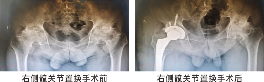 【保山安利醫(yī)院】長期飲酒導致雙側股骨頭壞死，髖關節(jié)置換后重獲運動功能！