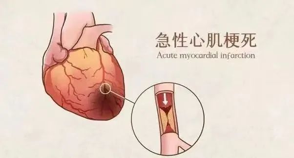【保山安利醫(yī)院】11月20日“心梗救治日” 時間就是心肌，時間就是生命！